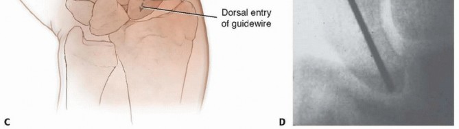 Illustration 8 for Mastering Percutaneous Fixation of Acute Scaphoid Fractures