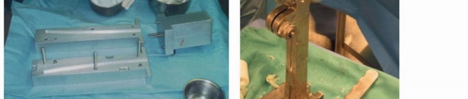 Illustration 4 for PJI of the Hip: Two-Stage Revision: When & How to Prepare