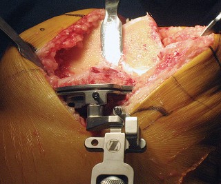 Illustration 17 for Posterior Stabilized Technique: Essential Insights for TKA Success