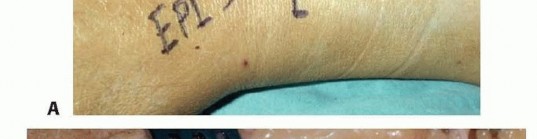 Illustration 11 for Precision Correction for Distal Radius Malunion