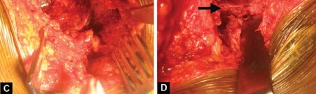 Illustration 37 for Total Hip Arthroplasty: Restoring Mobility in Juvenile Idiopathic Arthritis