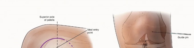Illustration 16 for Optimizing ACL Reconstruction for Skeletally Immature Patients