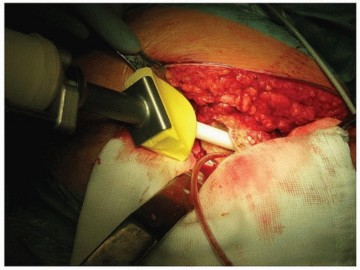 Illustration 29 for Why Polished Tapered Cemented Stems Excel in Hip Replacement