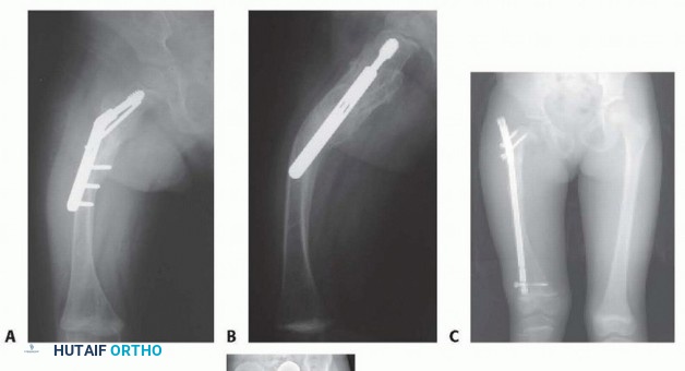 Illustration 3 for Less Pain, More Function: Fassier-Duval Nailing for Osteogenesis Imperfecta