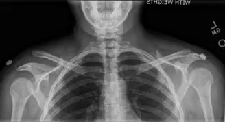 صورة توضيحية لـ انفصال المفصل الأخرمي الترقوي: دليلك الشامل للتشخيص والعلاج والتعافي مع الأستاذ الدكتور محمد هطيف