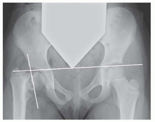 Valgus Osteotomy of the Proximal Femur: Solutions for Hip Health