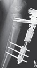 Illustration 16 for Conquering Adolescent Blount's Disease: A Surgical Guide