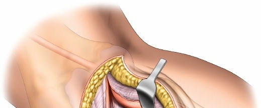 Illustration 43 for Surgical Access: Mastering the Tibia's Surface & Fibula Approaches