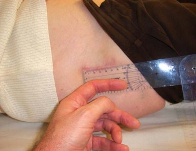 Illustration 21 for Mastering the Anterolateral Approach in Minimally Invasive Hip Replacement