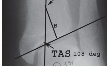 Illustration 2 for Unlock Ankle Preservation: Supramalleolar Closing Wedge Osteotomy