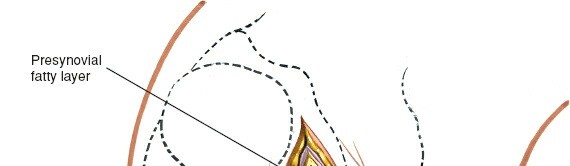 Illustration 50 for Mastering Knee Approaches: Spotlight on Superficial Medial Ligament