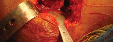 Illustration 27 for The Silent Hip: Achieving a Truly Silent, Pain-Free Joint