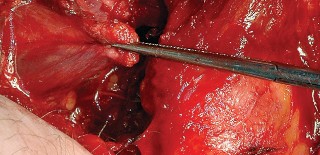 Illustration 69 for Unlock the Figure Posterior Approach to the Hip