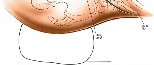 Illustration 4 for Master the Anterolateral Retroperitoneal Approach to Lumbar Spine