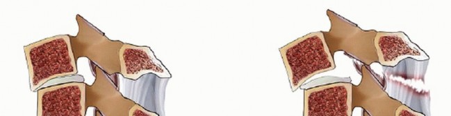 Illustration 27 for Master Techniques for Cervical Fracture Reduction: Type III & More