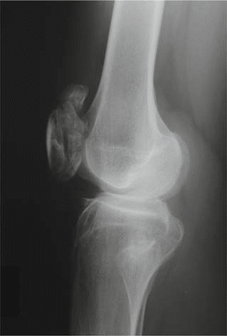 Illustration 3 for Understanding Multiple Epiphyseal Dysplasia: Orthopedic Cases