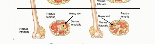 Illustration 35 for Precision Biopsy of Musculoskeletal Tumors for Accurate Diagnosis