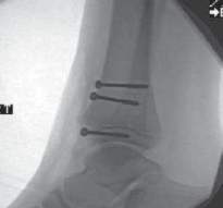 Illustration 45 for Pediatric Ankle Fractures: Management to Prevent Long-Term Issues