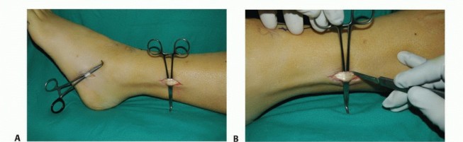 Illustration 41 for Foot Drop Surgery: How a Pin or Drill Elevates Tendon Transfer