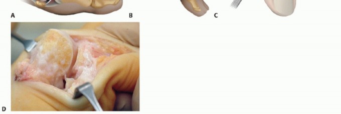 Illustration 8 for Mastering Extensive Plantar Release for Hallux Rigidus