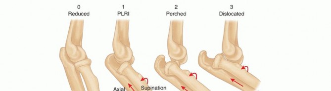 Management of Simple Elbow Dislocation