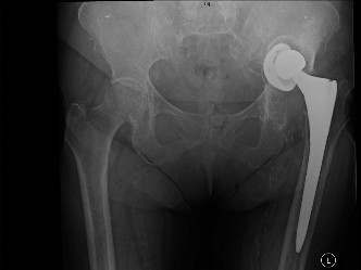 Painful Total Hip: Why It Hurts & What to Do Next