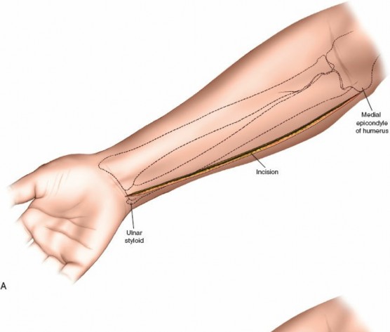 Illustration 93 for Mastering Approaches to the Upper Third of the Radius