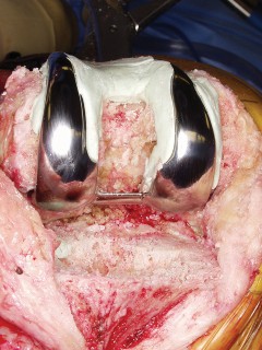 Illustration 33 for PROSTALAC Articulating Spacer: Treat Infected Knees, Regain Mobility