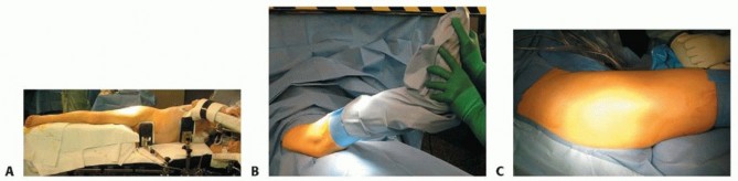 Illustration 4 for Proximal Femoral Osteotomy: When This Hip-Saving Surgery Is Performed