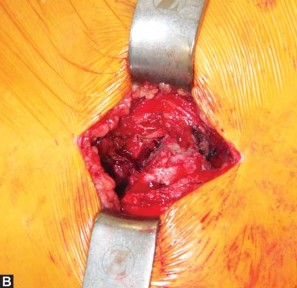 Illustration 19 for Exploring the Ambulatory Surgical Setting for Total Hip Replacement