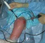 Illustration 14 for Capsular Releases for Loss of Motion: Restore Your Shoulder