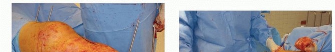 Illustration 20 for Tibia External Fixation: See How Pins Are Placed for Healing