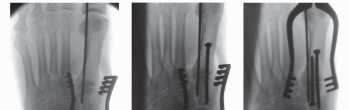 Illustration 17 for Fixation of Lisfranc Injuries: Essential Open Reduction Guide