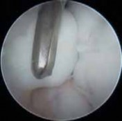 Illustration 35 for Precision Arthroscopy for Chondral Injuries & OCD: Direct Lateral Portal