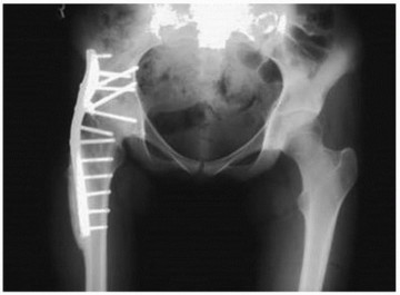 Illustration 21 for Hip Arthrodesis: The Definitive Hip Solution for Active Young Adults