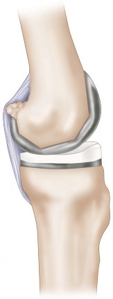 Illustration 5 for Posterior Cruciate Ligament-Retaining TKA: Navigating Pitfalls