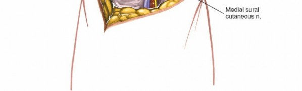 Illustration 190 for Mastering Knee Approaches: Spotlight on Superficial Medial Ligament