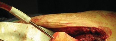 Illustration 58 for Figure Hip Resurfacing: Who Benefits and Who Should Avoid It?