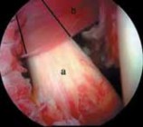 Illustration 3 for Capsular Releases for Loss of Motion: Restore Your Shoulder