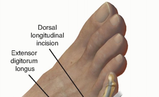 Illustration 24 for Toe Deformity Pain? Rebalance Flexor to Extensor for Relief