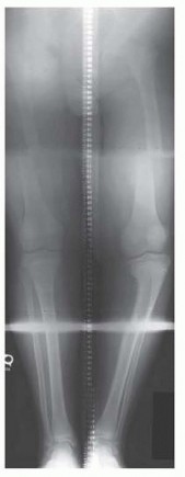 Illustration of infantile blount disease - Dr. Mohammed Hutaif