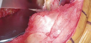 Illustration 48 for Mastering Valgus Total Knee Replacement: Techniques & Pitfalls