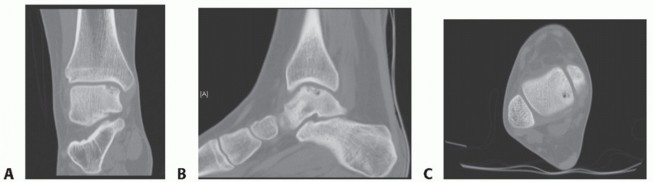 Illustration 3 for Painful Talus Lesions? The tech fig c Osteochondral Transfer Solution