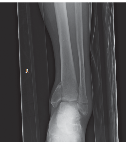 Understanding a Complex Case Ankle Fracture: Classification & Management