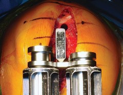 Illustration 48 for Mastering TKA: Essential Methods of Rotational Alignment