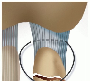 Illustration 30 for Restore Your Foot: Surgical Treatment for Hallux MP Joint Turf Toe