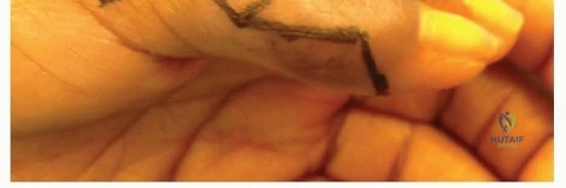 صورة توضيحية لـ آلام القدم والكاحل: دليل شامل للمرضى لخطوات التشخيص والعلاج والتعافي مع الأستاذ الدكتور محمد هطيف