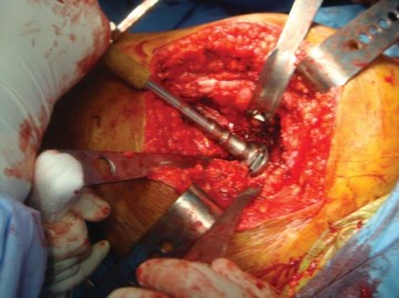 Illustration 20 for The Silent Hip: Achieving a Truly Silent, Pain-Free Joint