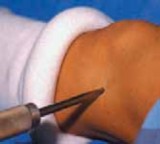 Illustration 6 for Percutaneous Epiphysiodesis: Precisely Closing the Third of the Physis