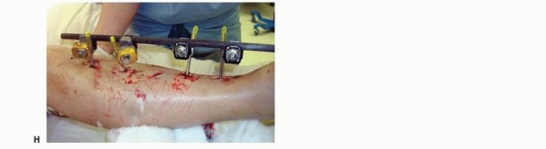 Illustration 33 for Tibia External Fixation: See How Pins Are Placed for Healing